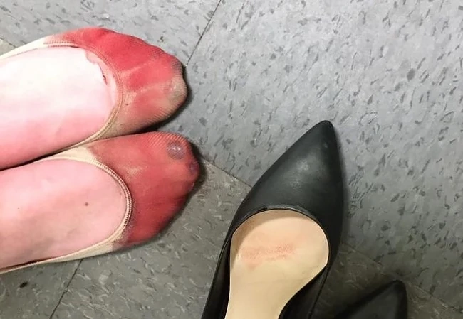 Ужас! Вижте краката на сервитьорка, принудена да носи високи обувки! (18+)