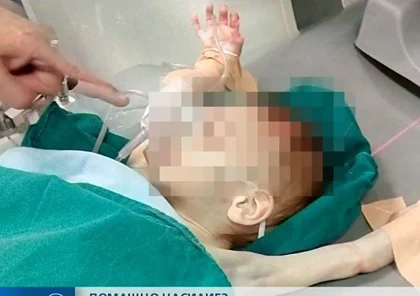 Остава тежко състоянието на едно от близначетата в Пловдив