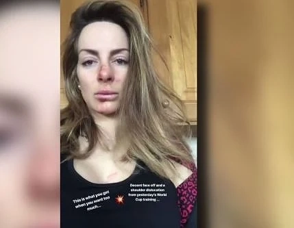 Сани Жекова с извадено рамо и ожулено лице (СНИМКА)