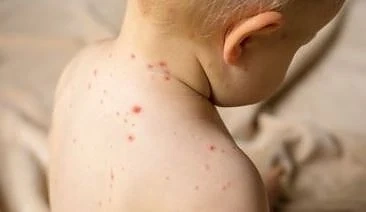 Първи случаи на морбили в Пловдив и Бургас