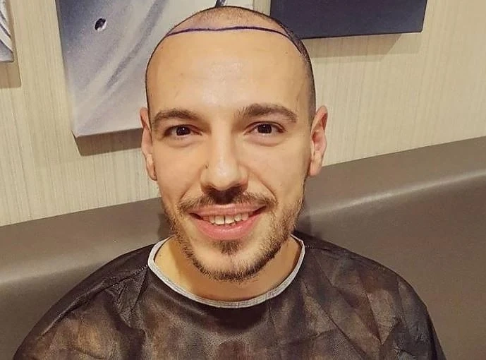 Дани Петканов си присади коса