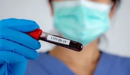 77 нови случаи на COVID-19 у нас