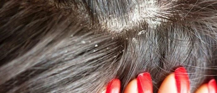 Пърхотът е предупреждение за страшна болест