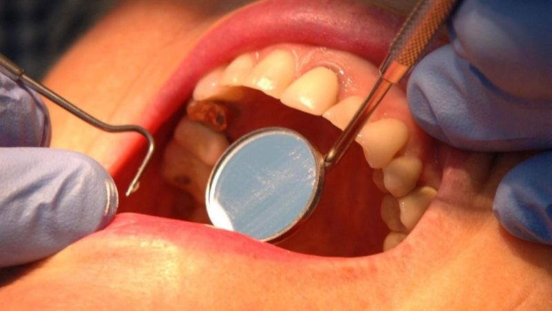 Необичаен симптом за предстоящ инфаркт издават зъбите