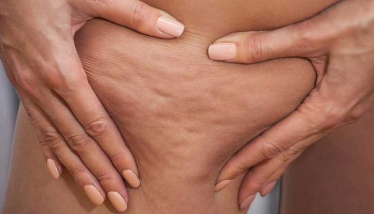 4 мита за целулита, в които още вярваме