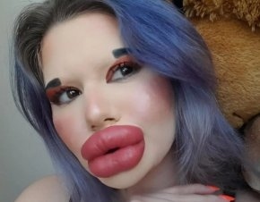 Най-голямата уста в света е на българка, ще я инжектира за 27-и път за Коледа