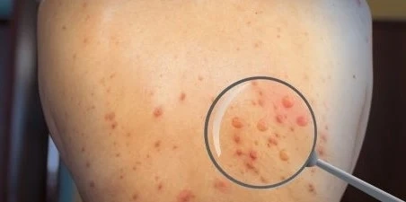 Два случая на маймунска шарка са потвърдени в България