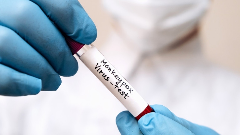 Четвърти заразен с маймунска шарка у нас