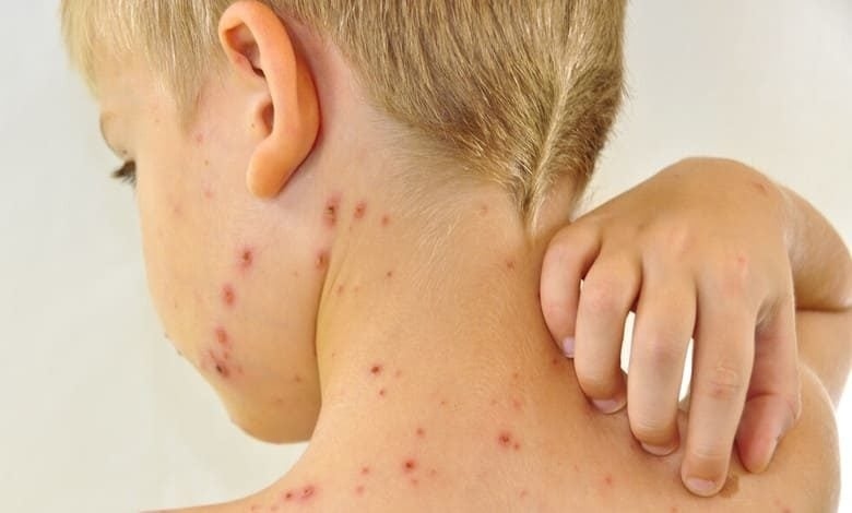 Пик на случаите на варицела в страната: Къде има най-много заболели