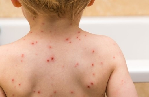 Бум на варицелата в страната
