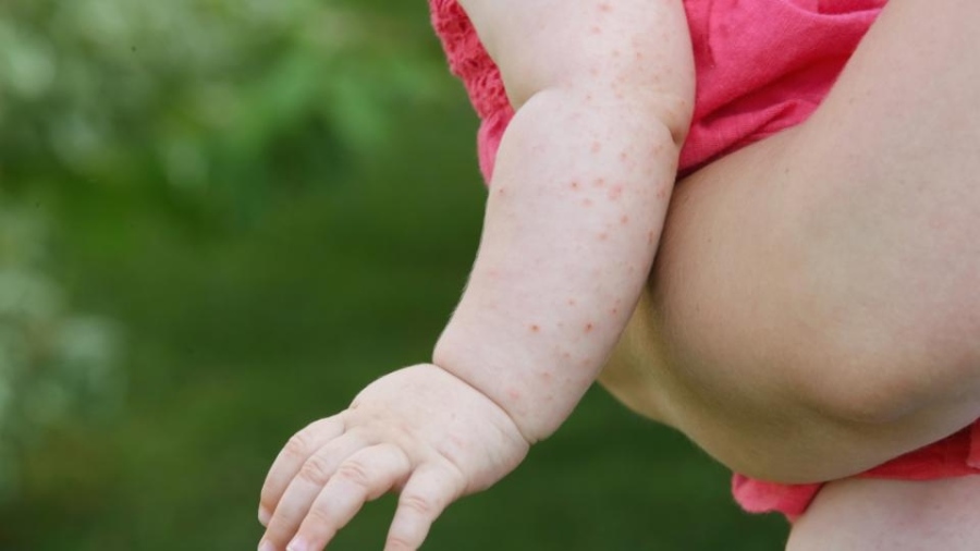 В кантон Сараево е обявена епидемия от морбили