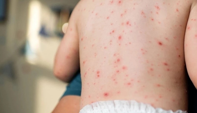 Проф. Ива Христова: Няма епидемия от морбили, а епидемичен взрив