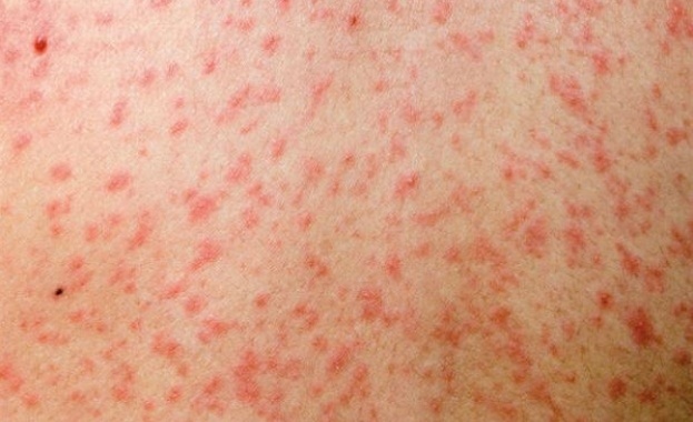 Расте броят на случаите на морбили у нас 