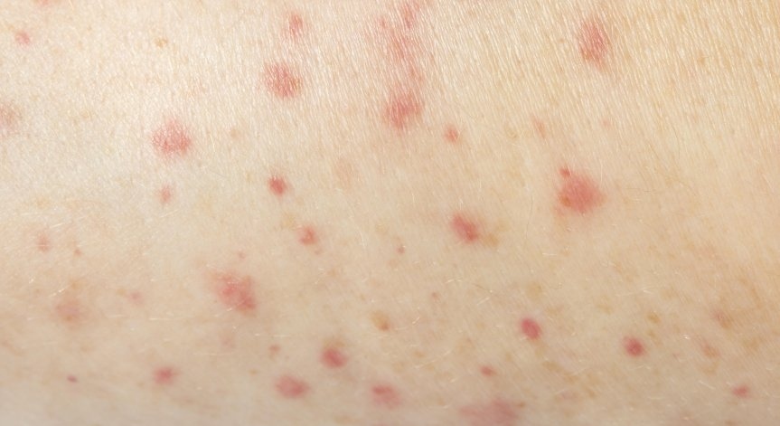 Нови случаи на морбили у нас, заболелите вече са 191 души